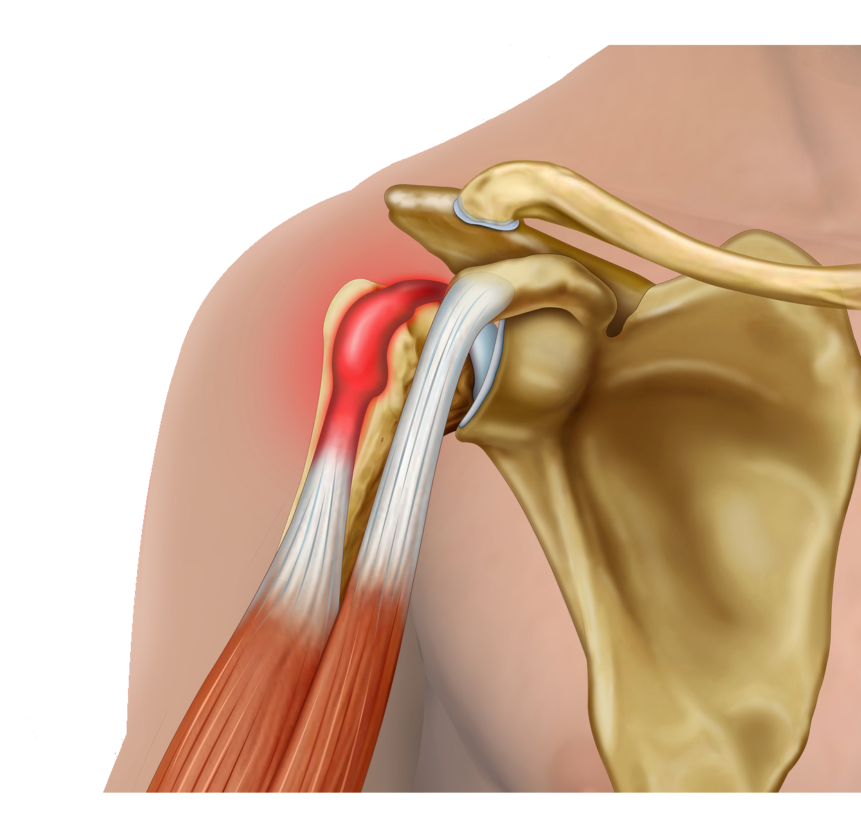 Biceps tendonitis